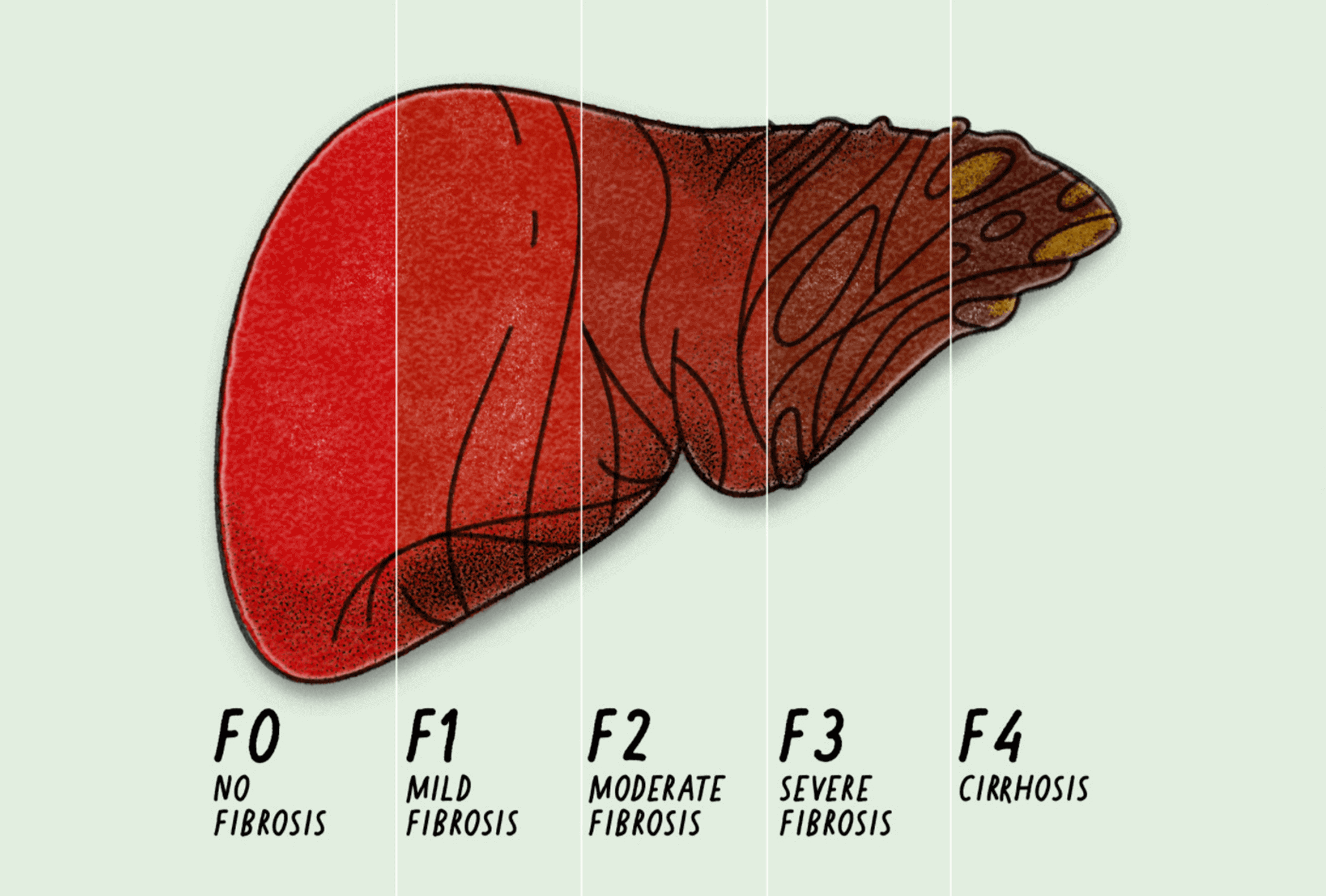 How Hepatitis C Affects The Liver Interactive Animation